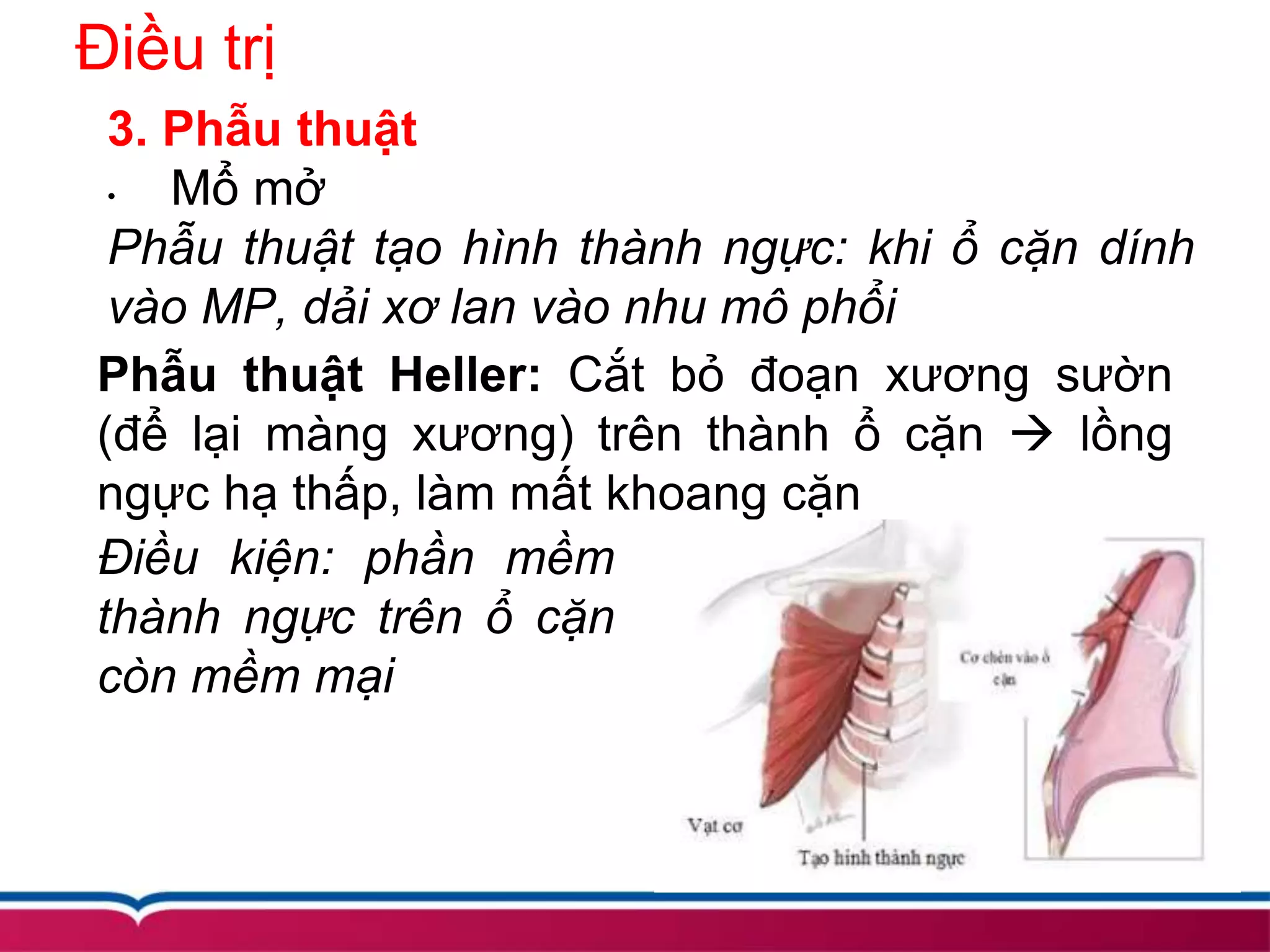 Điều trị
3. Phẫu thuật
• Mổ mở
Phẫu thuật tạo hình thành ngực: khi ổ cặn dính
vào MP, dải xơ lan vào nhu mô phổi
Phẫu thuật Heller: Cắt bỏ đoạn xương sườn
(để lại màng xương) trên thành ổ cặn  lồng
ngực hạ thấp, làm mất khoang cặn
Điều kiện: phần mềm
thành ngực trên ổ cặn
còn mềm mại
 