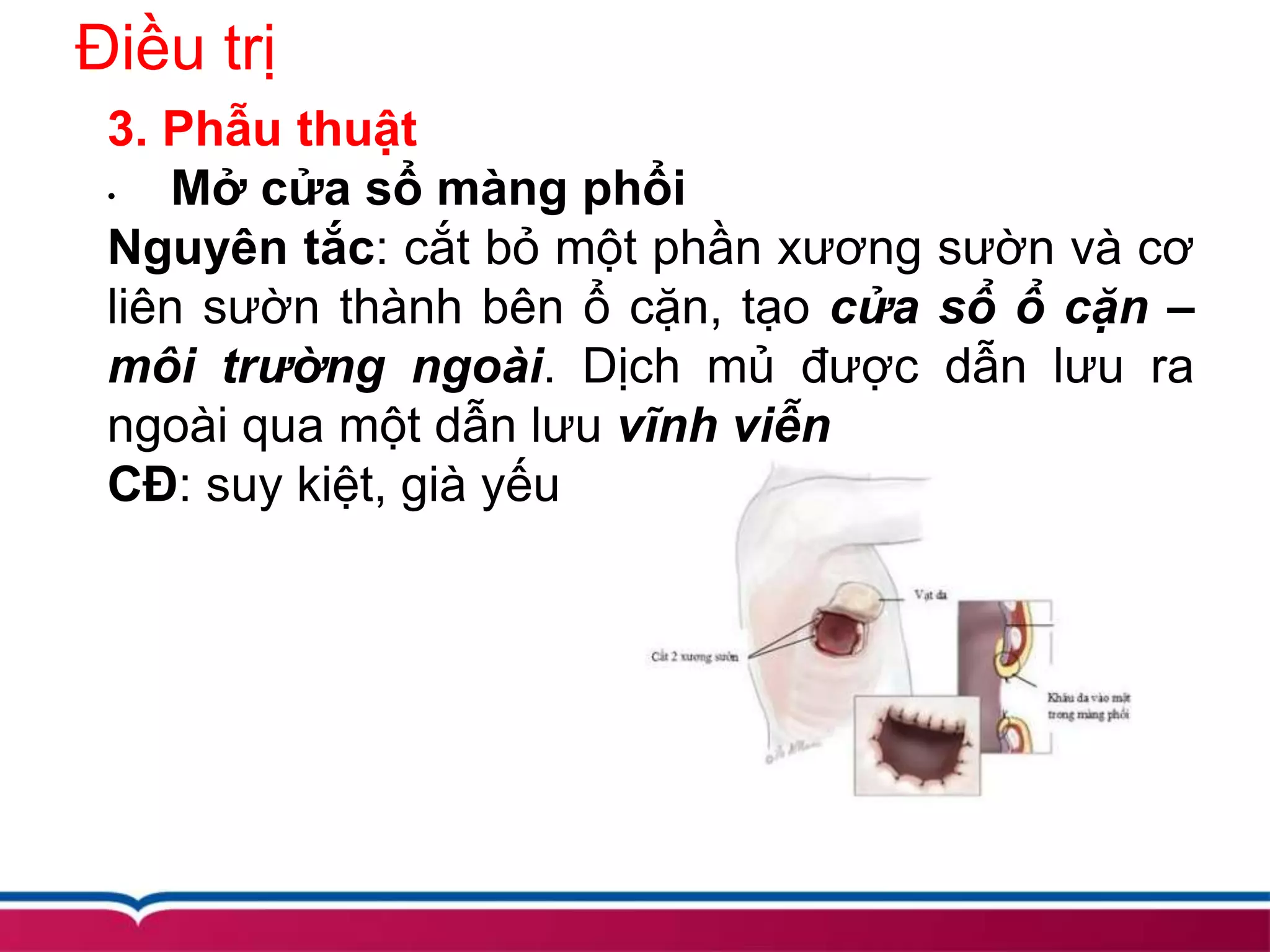 Điều trị
3. Phẫu thuật
• Mở cửa sổ màng phổi
Nguyên tắc: cắt bỏ một phần xương sườn và cơ
liên sườn thành bên ổ cặn, tạo cửa sổ ổ cặn –
môi trường ngoài. Dịch mủ được dẫn lưu ra
ngoài qua một dẫn lưu vĩnh viễn
CĐ: suy kiệt, già yếu
 