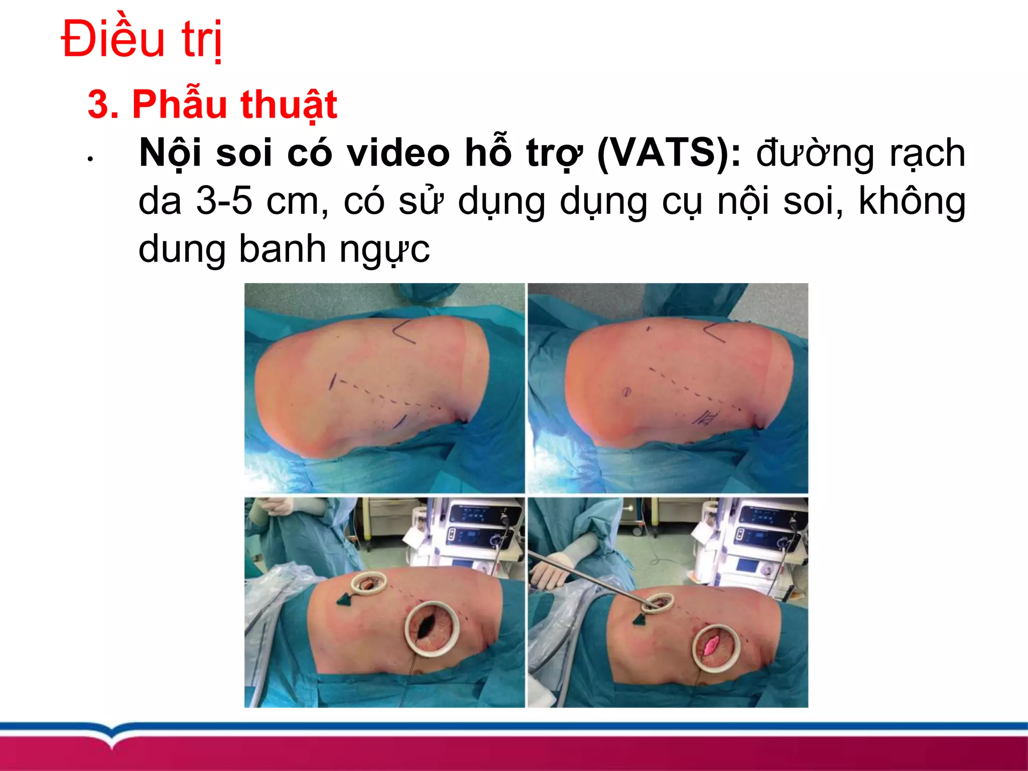 Điều trị
3. Phẫu thuật
• Nội soi có video hỗ trợ (VATS): đường rạch
da 3-5 cm, có sử dụng dụng cụ nội soi, không
dung banh ngực
 