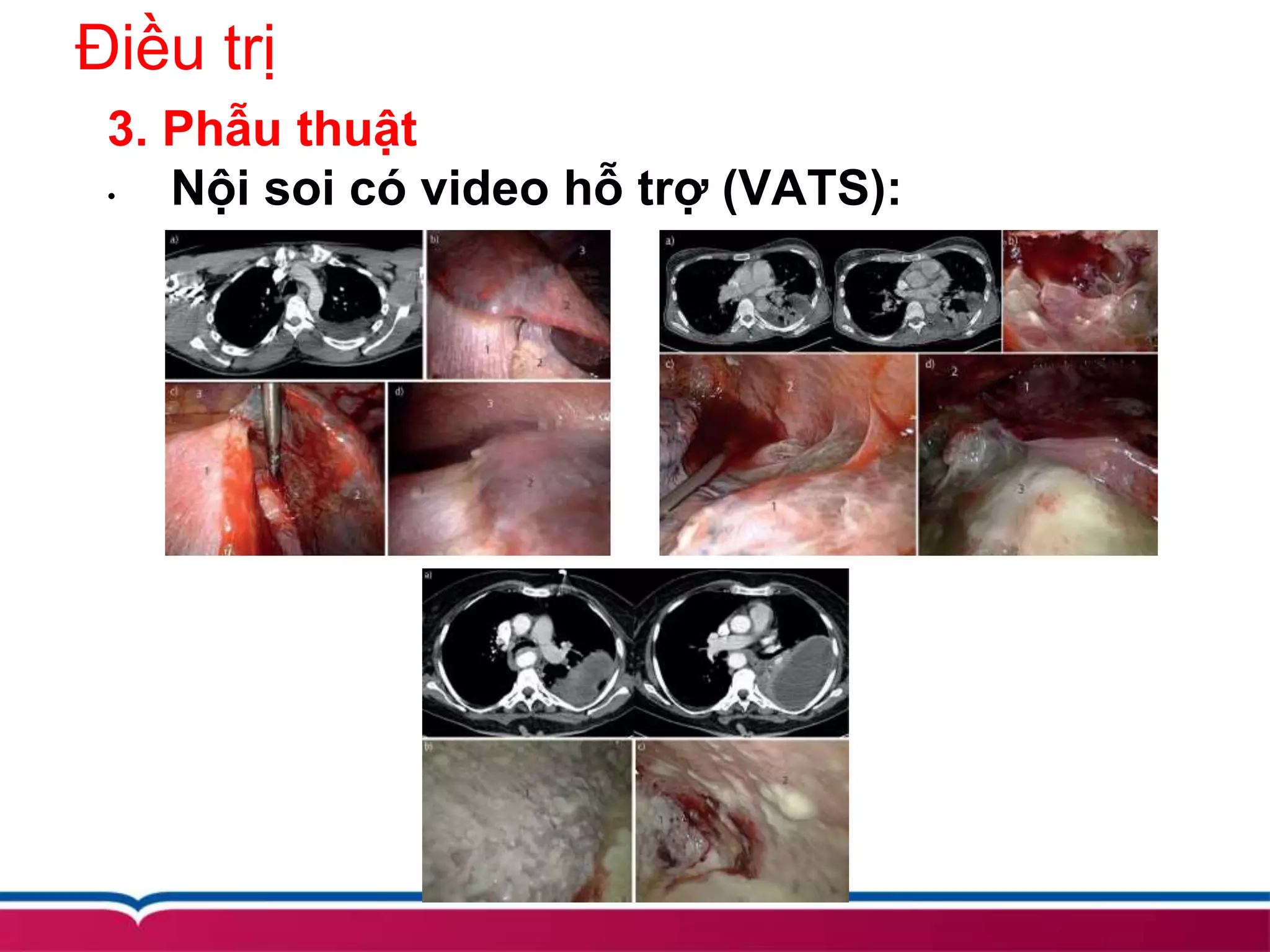 Điều trị
3. Phẫu thuật
• Nội soi có video hỗ trợ (VATS):
 