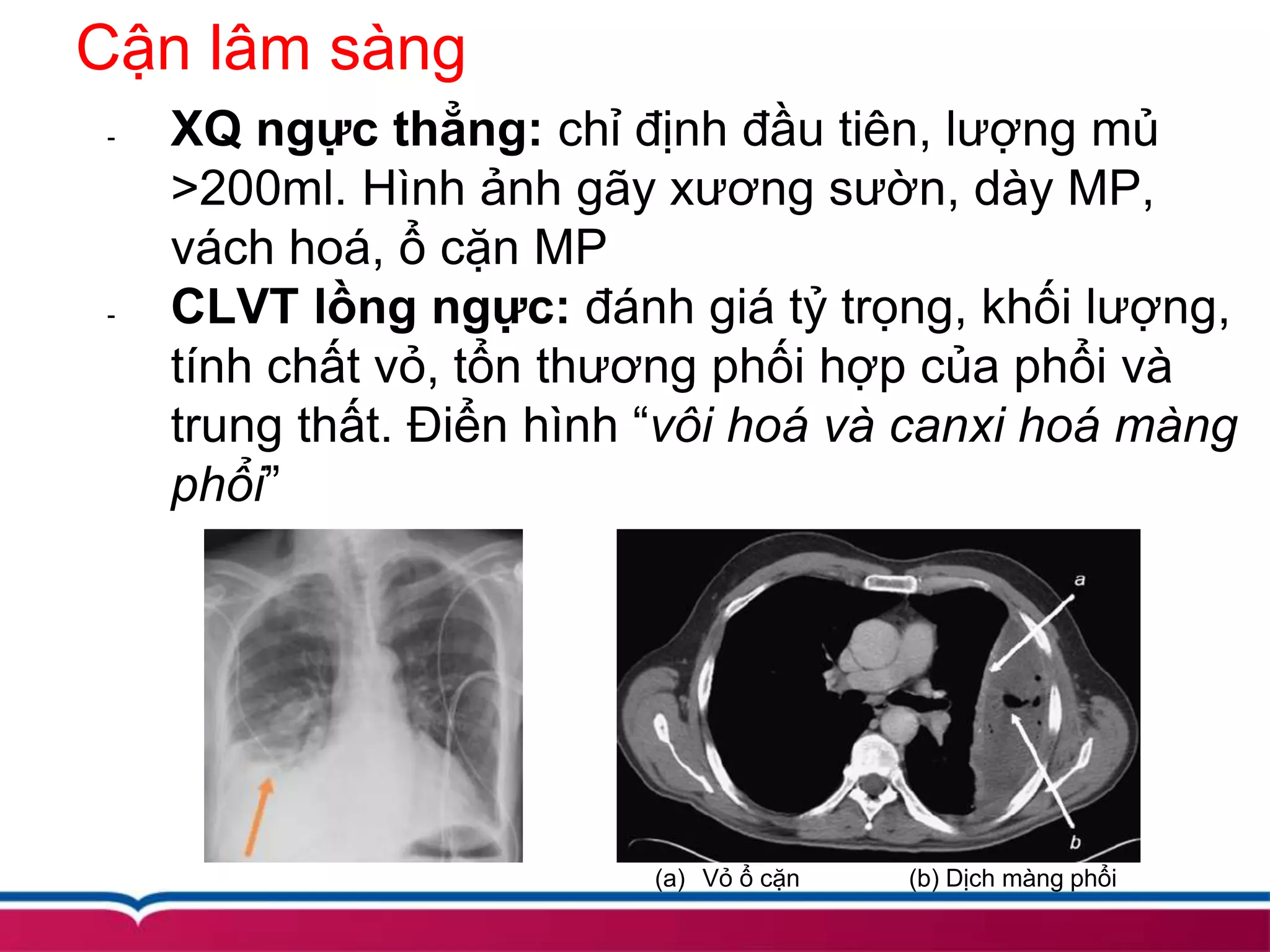 Cận lâm sàng
- XQ ngực thẳng: chỉ định đầu tiên, lượng mủ
>200ml. Hình ảnh gãy xương sườn, dày MP,
vách hoá, ổ cặn MP
- CLVT lồng ngực: đánh giá tỷ trọng, khối lượng,
tính chất vỏ, tổn thương phối hợp của phổi và
trung thất. Điển hình “vôi hoá và canxi hoá màng
phổi”
(a) Vỏ ổ cặn (b) Dịch màng phổi
 