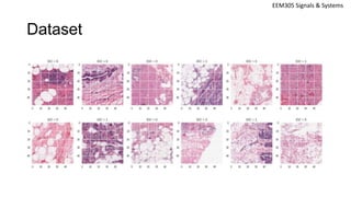 Breast Cancer Detection with Convolutional Neural Networks (CNN) | PPTX