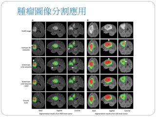 腫瘤圖像分割應用
 