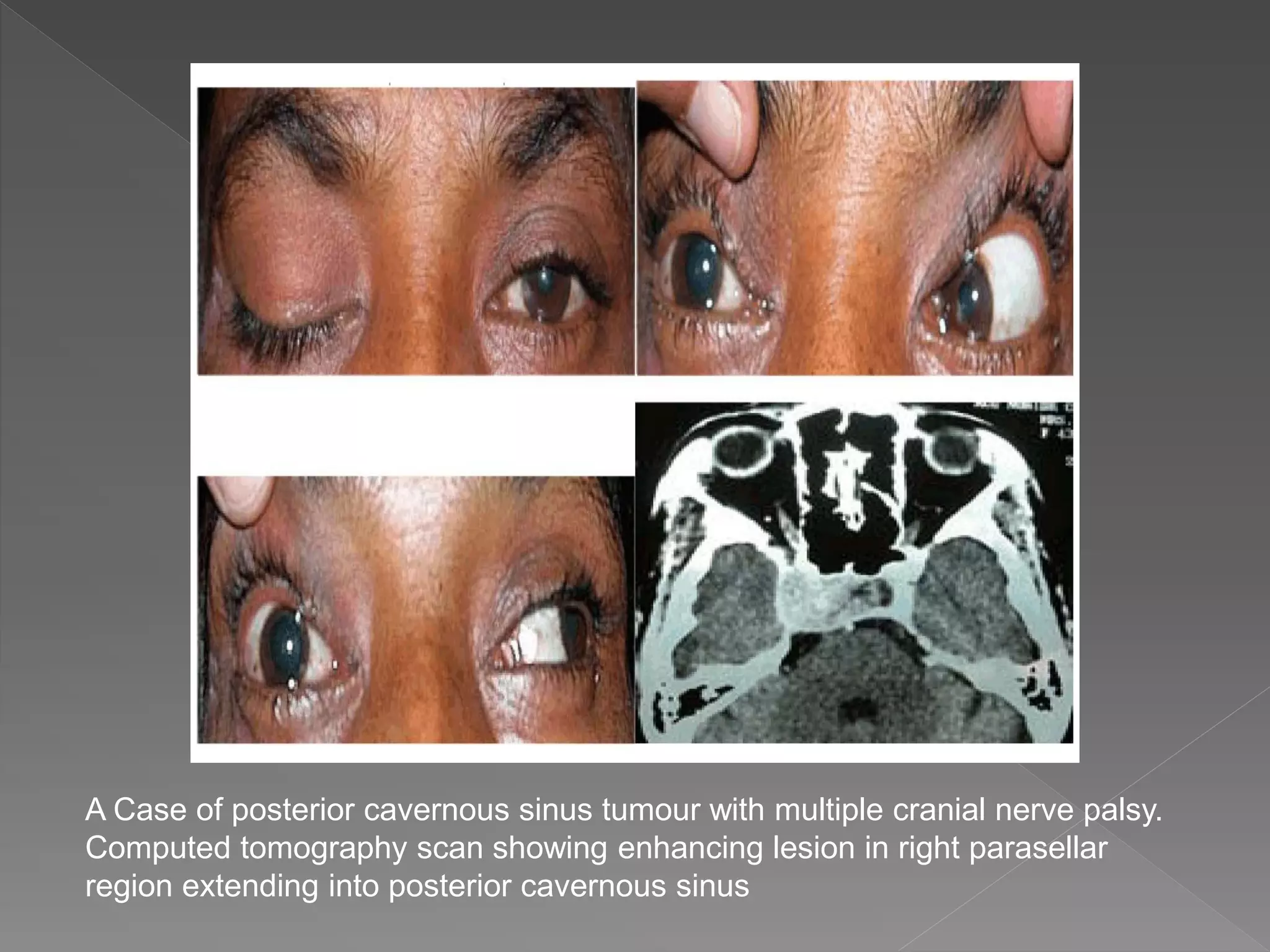 3rd, 4th, & 6th cranial nerve palsy | PPTX