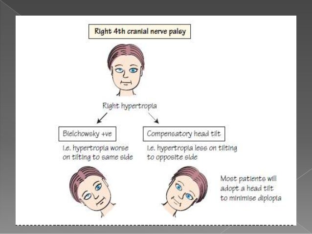 3rd, 4th, & 6th cranial nerve palsy