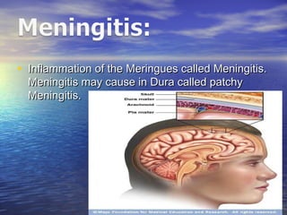 • Inflammation of the Meringues called Meningitis.Inflammation of the Meringues called Meningitis.
Meningitis may cause in Dura called patchyMeningitis may cause in Dura called patchy
Meningitis.Meningitis.
 