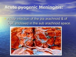 • Acute infection of the pia arachnoid & ofAcute infection of the pia arachnoid & of
CSF enclosed in the sub arachnoid space.CSF enclosed in the sub arachnoid space.
 