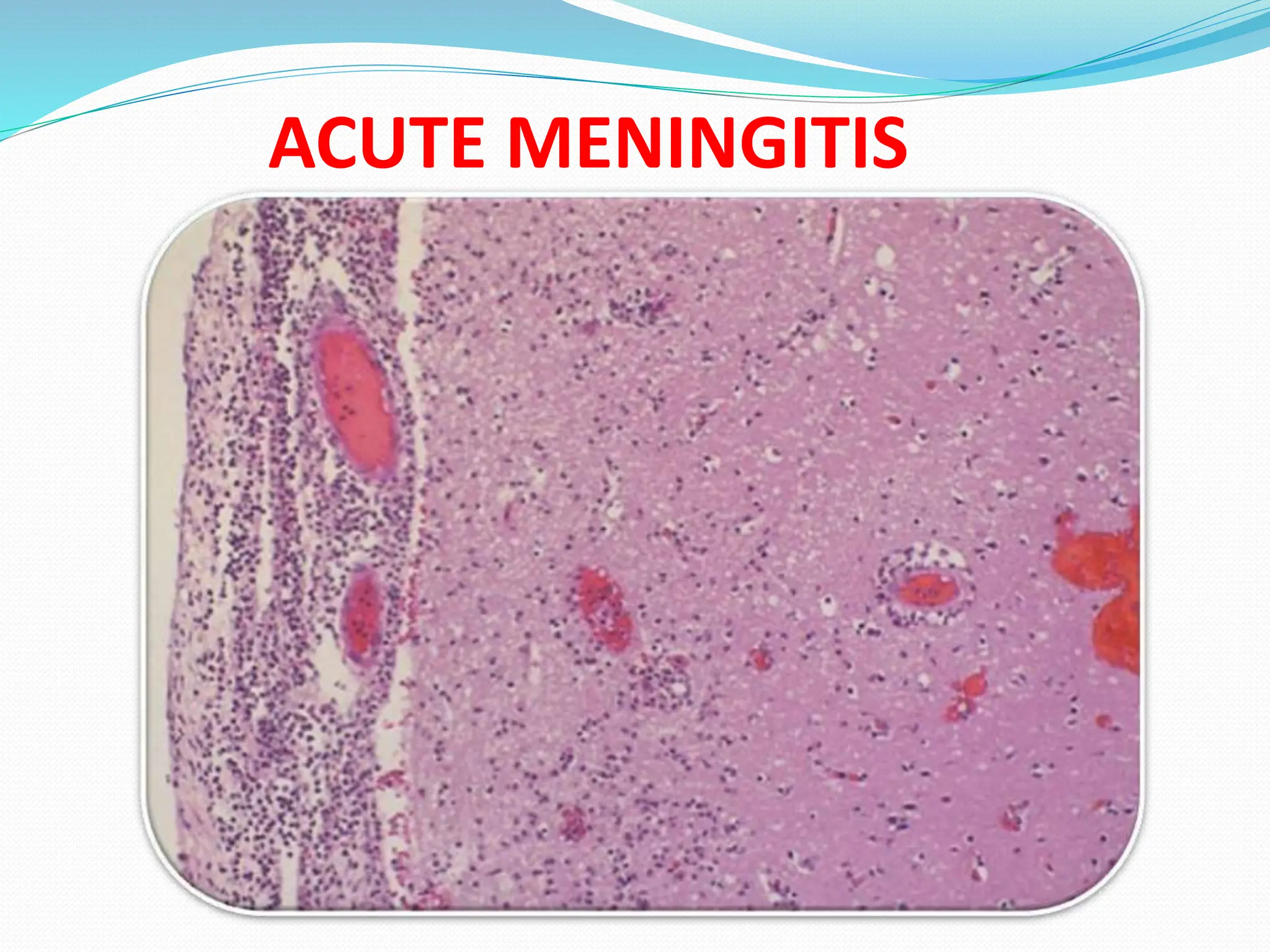 ACUTE MENINGITIS
 
