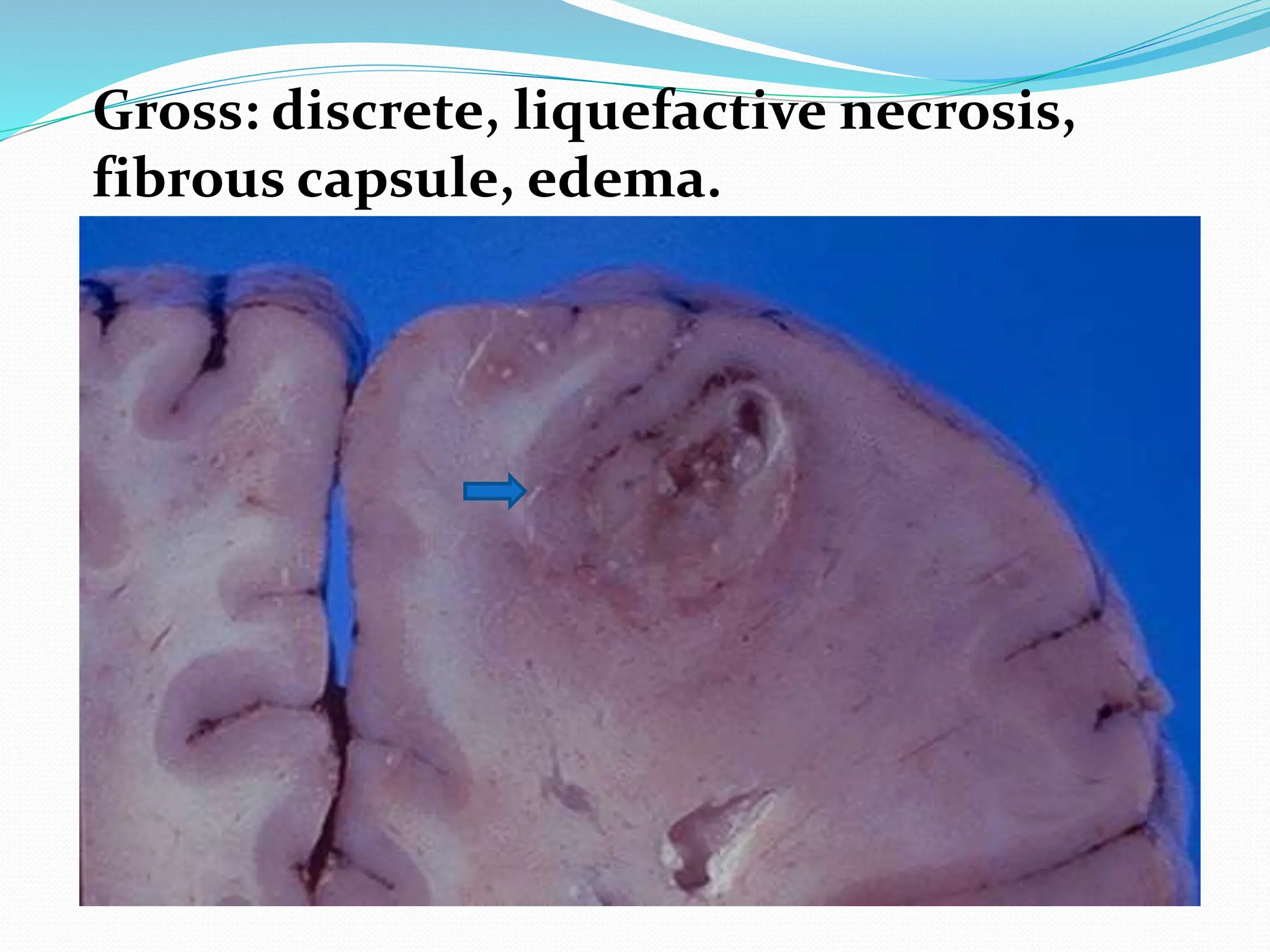 Gross: discrete, liquefactive necrosis,
fibrous capsule, edema.
 