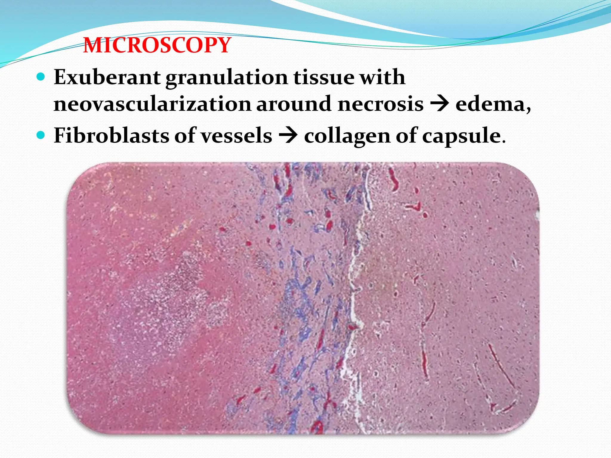 MICROSCOPY
 Exuberant granulation tissue with
neovascularization around necrosis  edema,
 Fibroblasts of vessels  collagen of capsule.
 