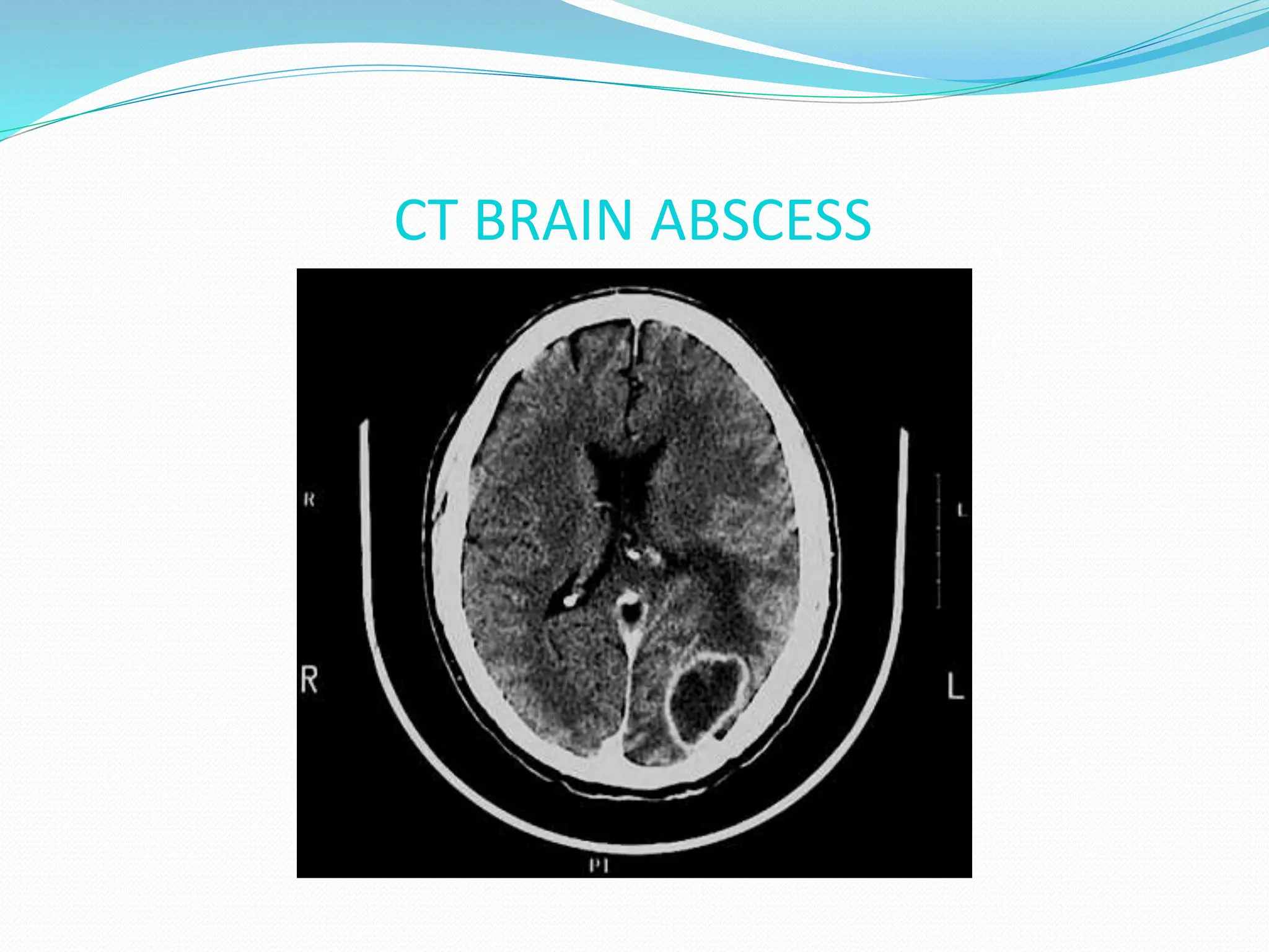 CT BRAIN ABSCESS
 