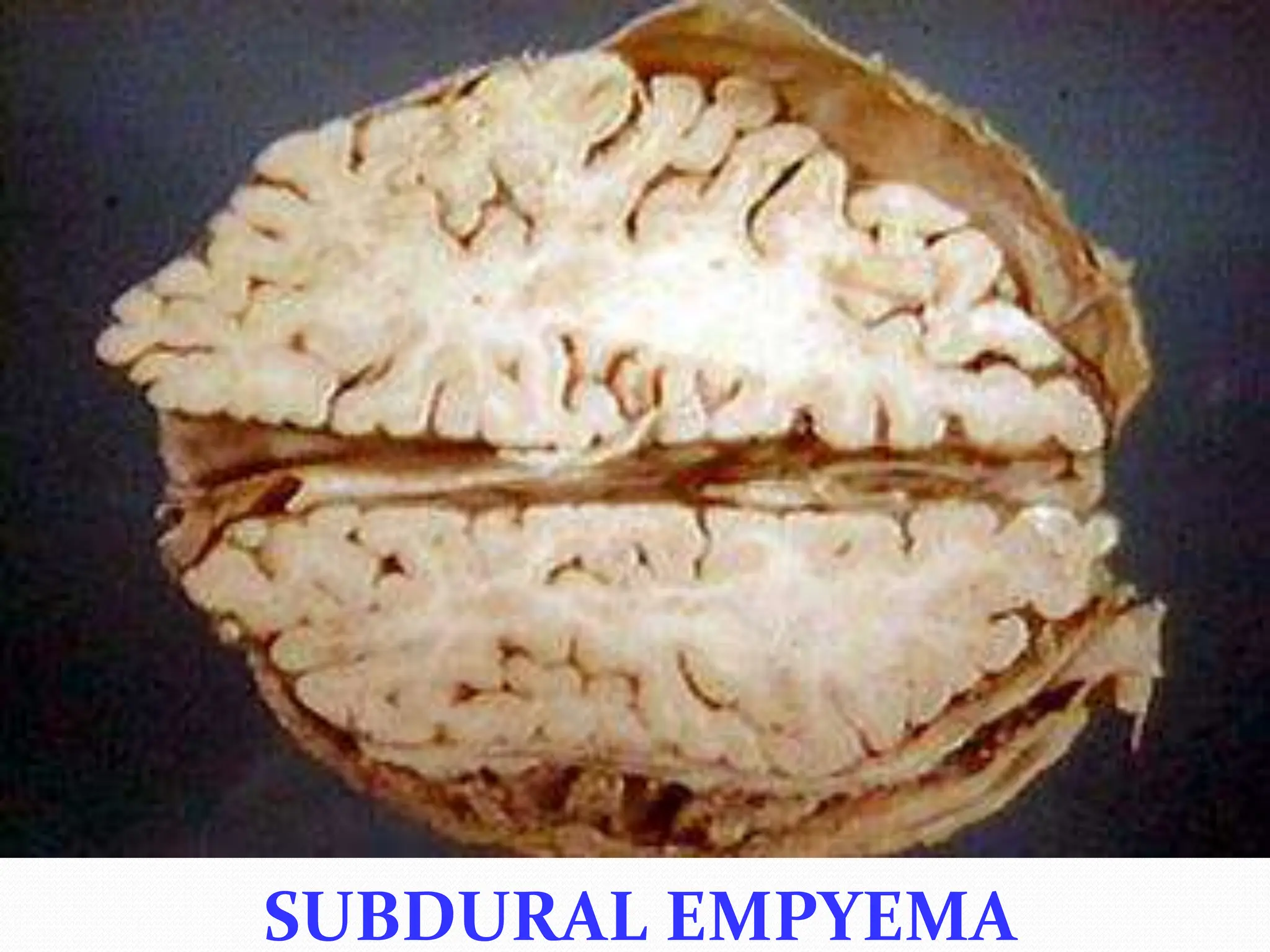 SUBDURAL EMPYEMA
 