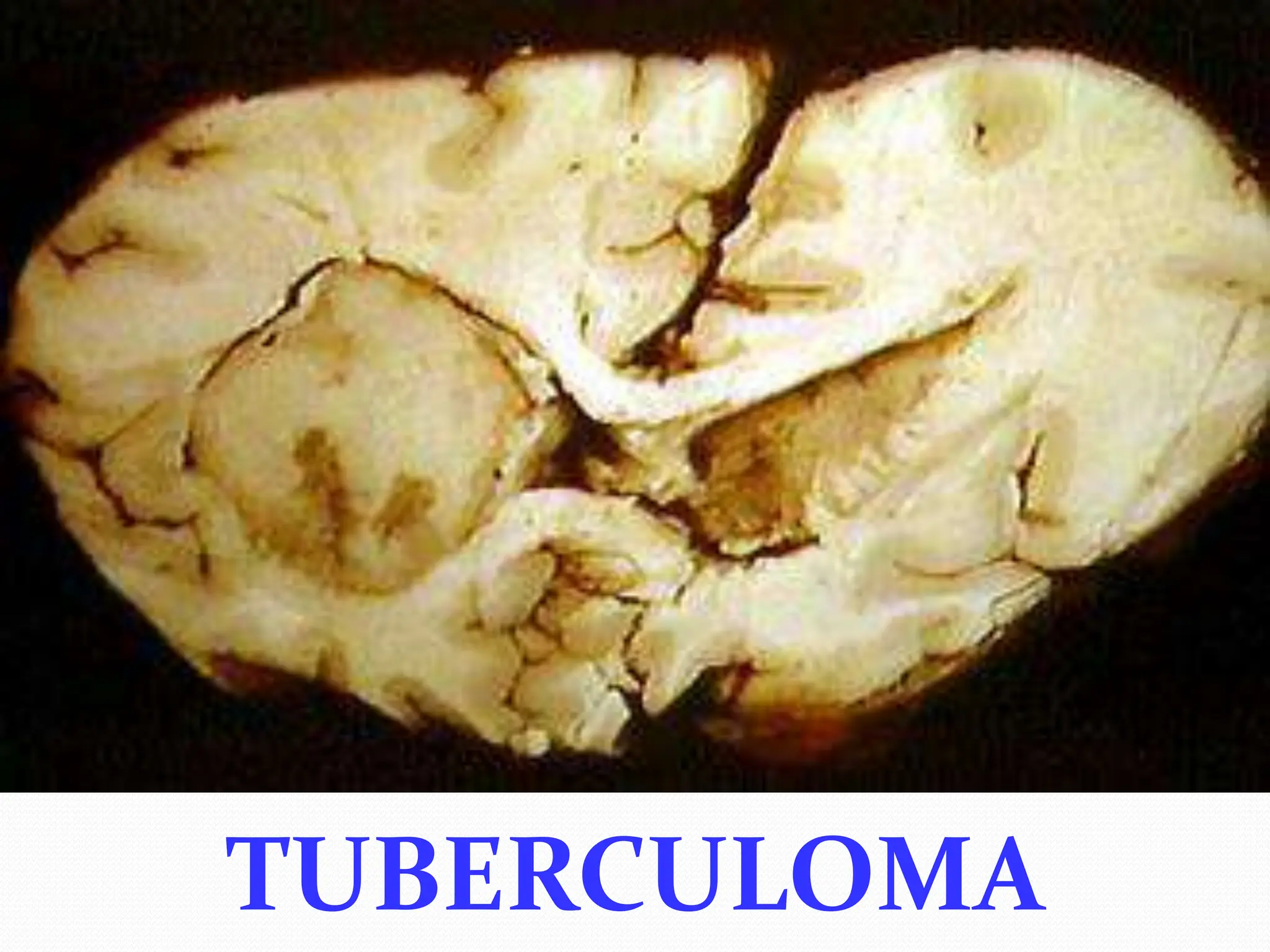 TUBERCULOMA
 