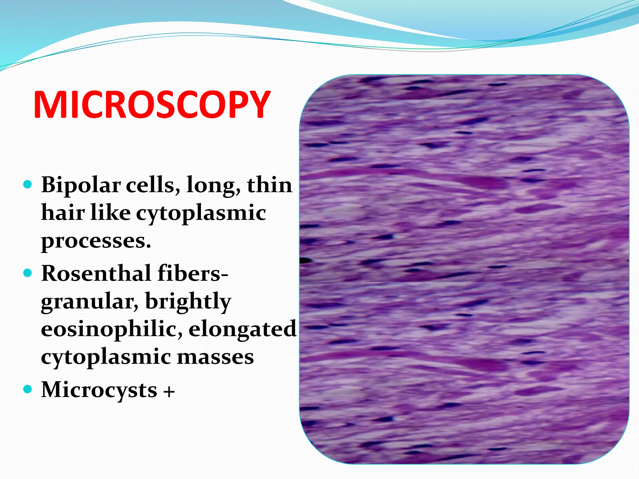 MICROSCOPY
 Bipolar cells, long, thin
hair like cytoplasmic
processes.
 Rosenthal fibers-
granular, brightly
eosinophilic, elongated
cytoplasmic masses
 Microcysts +
 