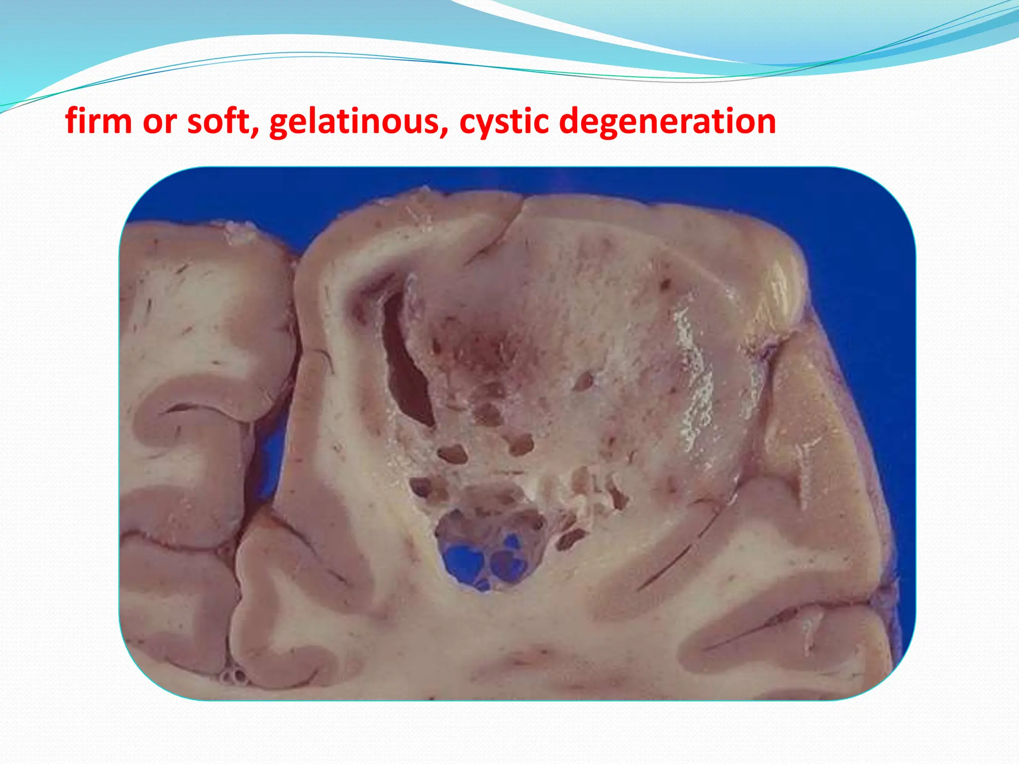 firm or soft, gelatinous, cystic degeneration
 