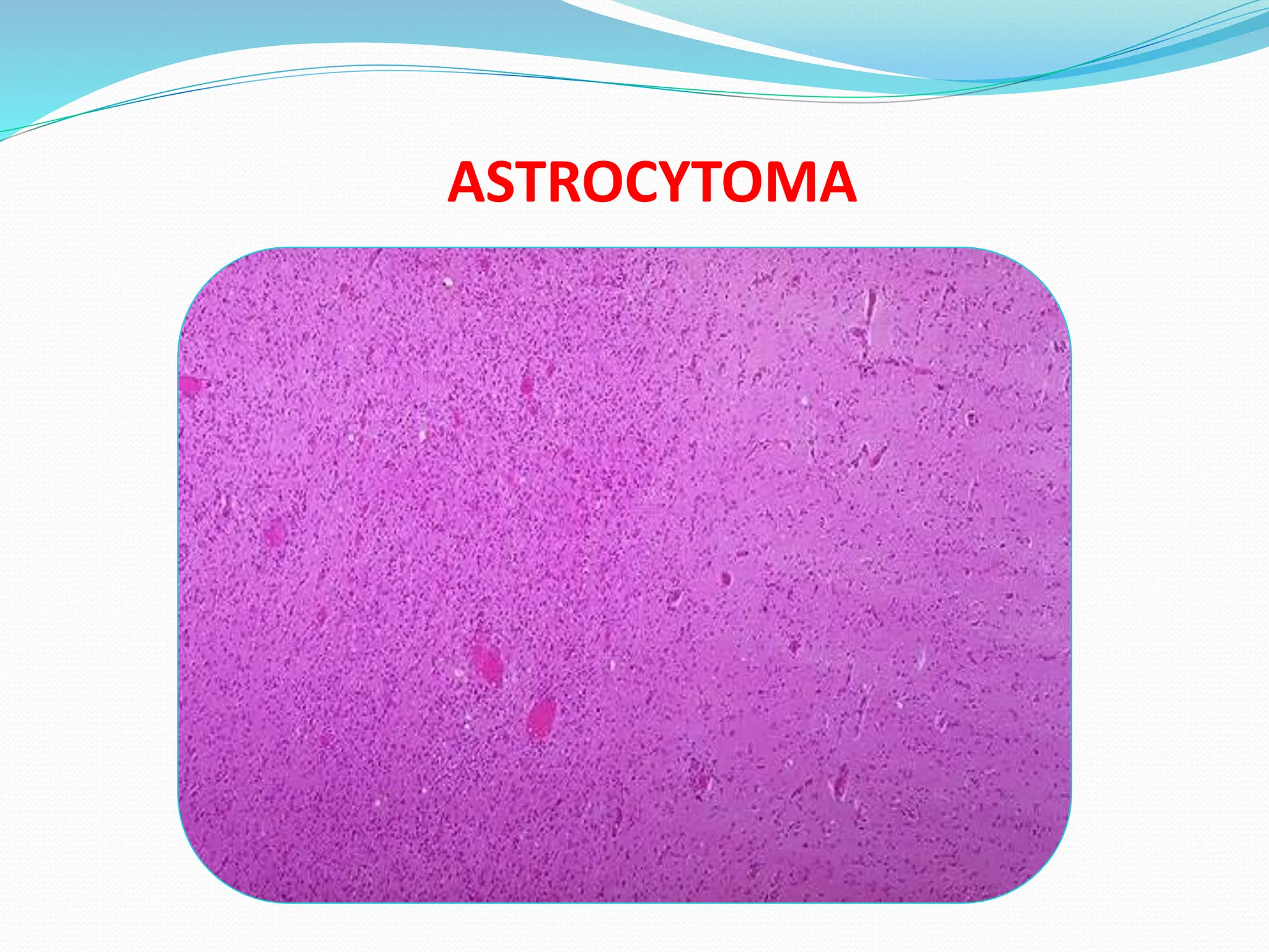 ASTROCYTOMA
 