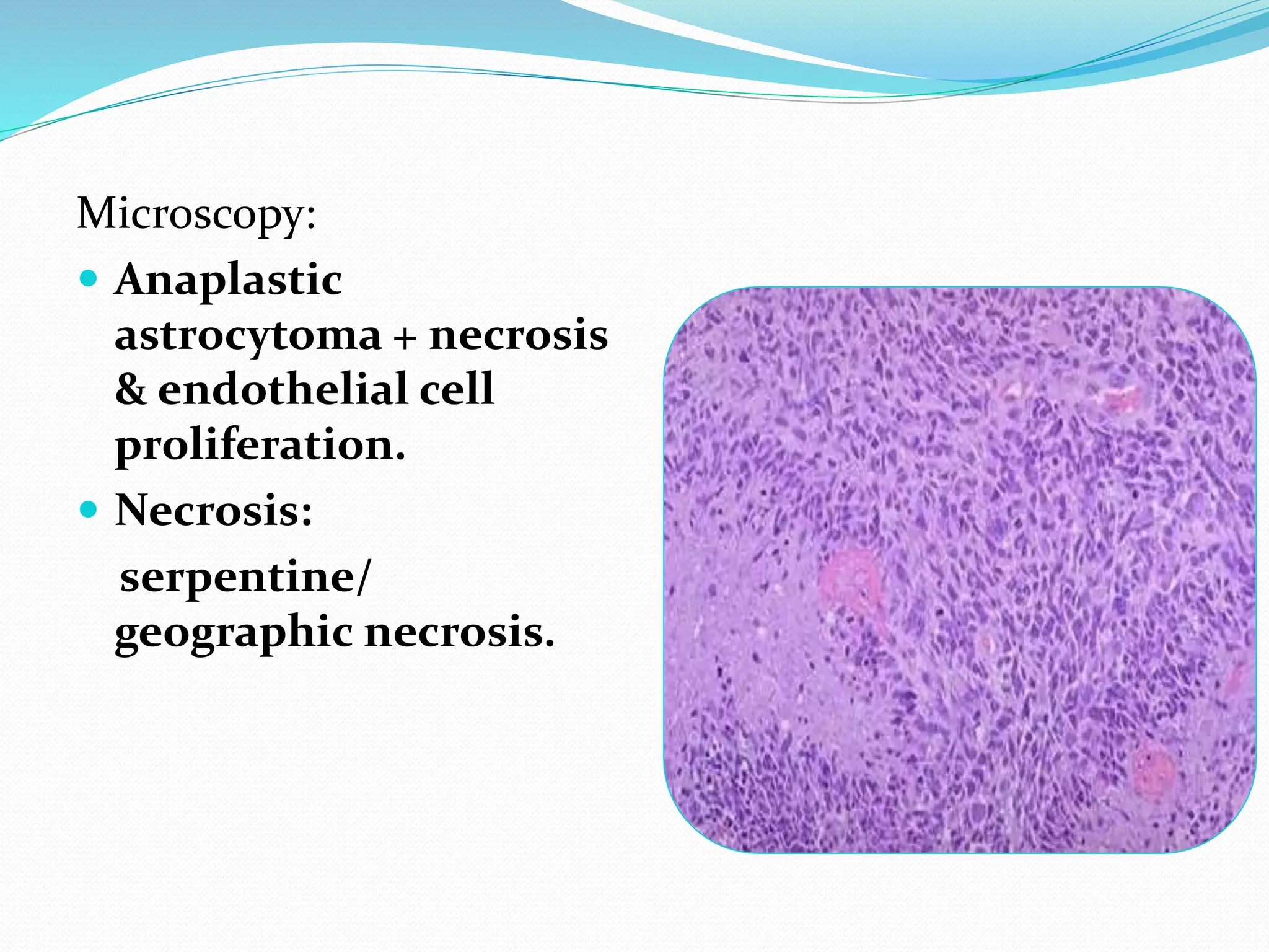 Microscopy:
 Anaplastic
astrocytoma + necrosis
& endothelial cell
proliferation.
 Necrosis:
serpentine/
geographic necrosis.
 