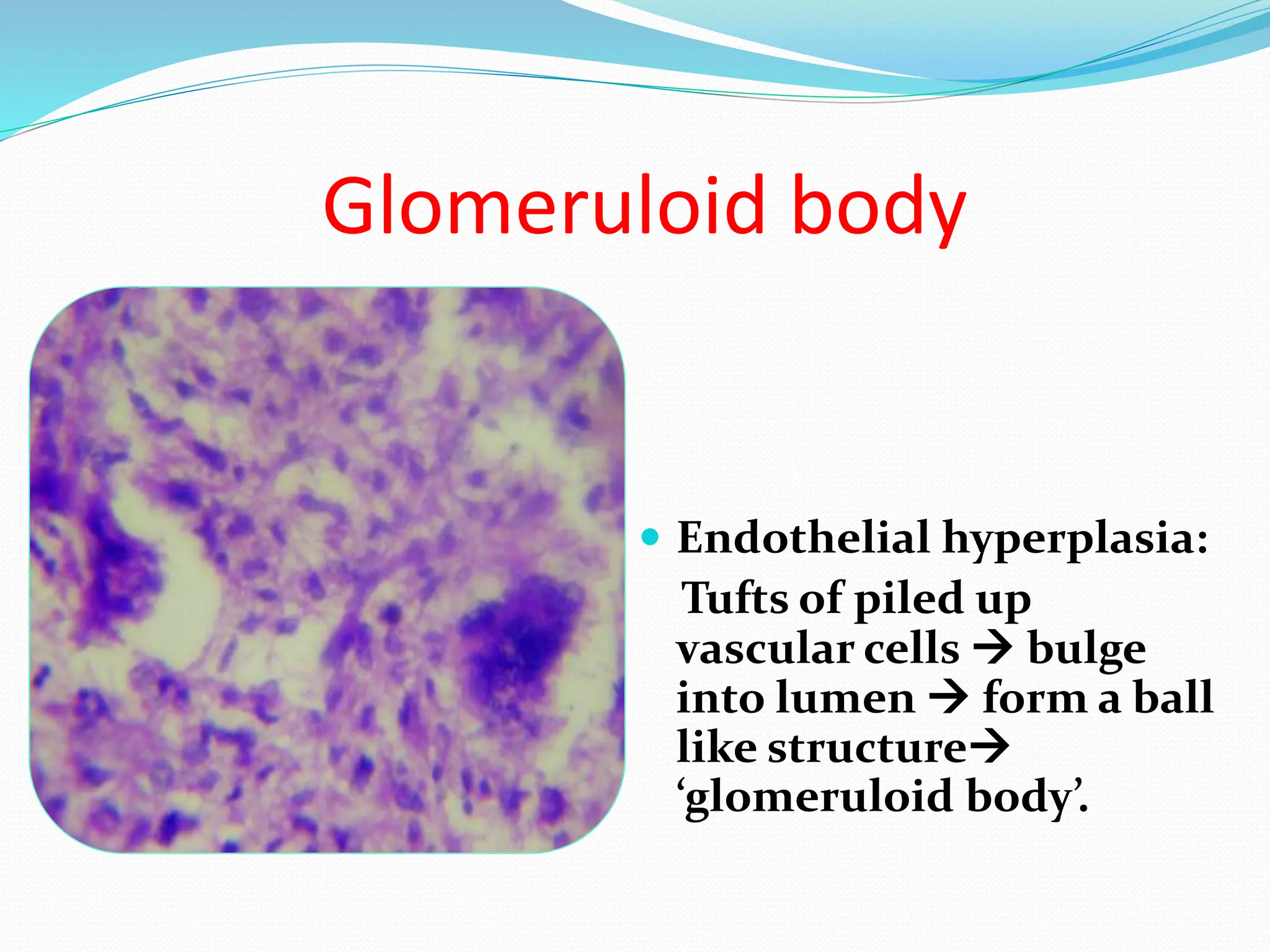 Glomeruloid body
 Endothelial hyperplasia:
Tufts of piled up
vascular cells  bulge
into lumen  form a ball
like structure
‘glomeruloid body’.
 