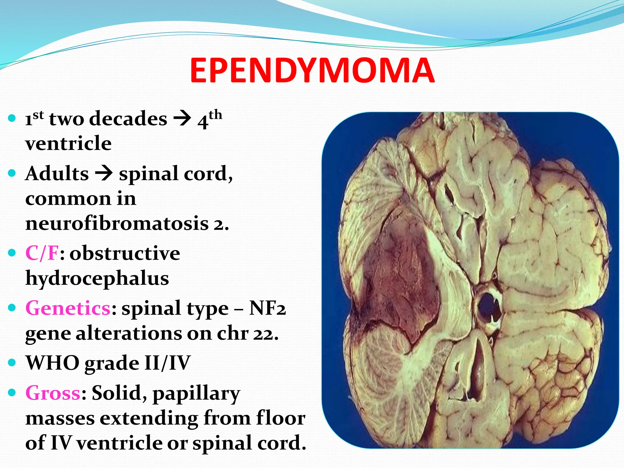 EPENDYMOMA
 1st two decades  4th
ventricle
 Adults  spinal cord,
common in
neurofibromatosis 2.
 C/F: obstructive
hydrocephalus
 Genetics: spinal type – NF2
gene alterations on chr 22.
 WHO grade II/IV
 Gross: Solid, papillary
masses extending from floor
of IV ventricle or spinal cord.
 