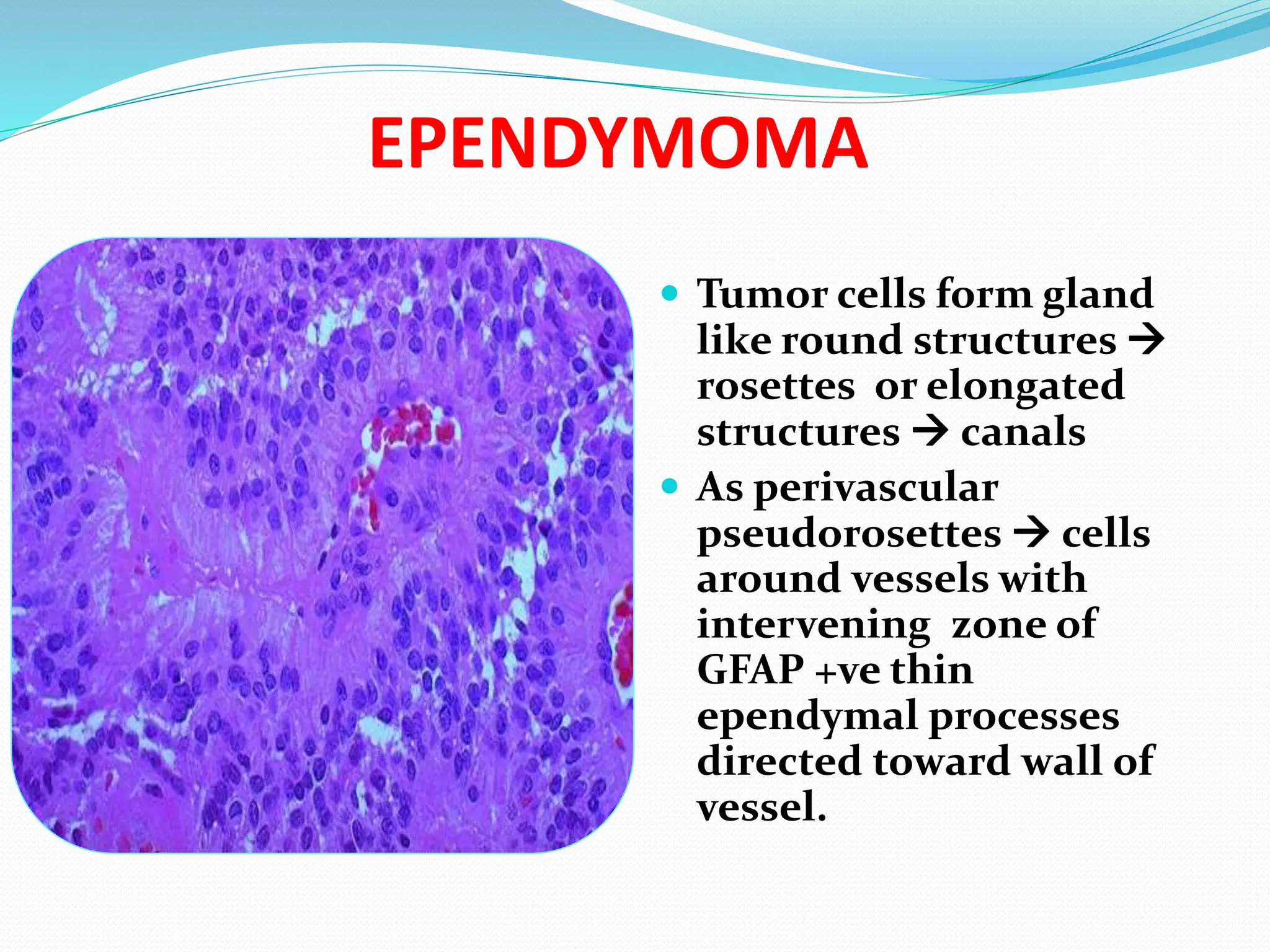EPENDYMOMA
 Tumor cells form gland
like round structures 
rosettes or elongated
structures  canals
 As perivascular
pseudorosettes  cells
around vessels with
intervening zone of
GFAP +ve thin
ependymal processes
directed toward wall of
vessel.
 