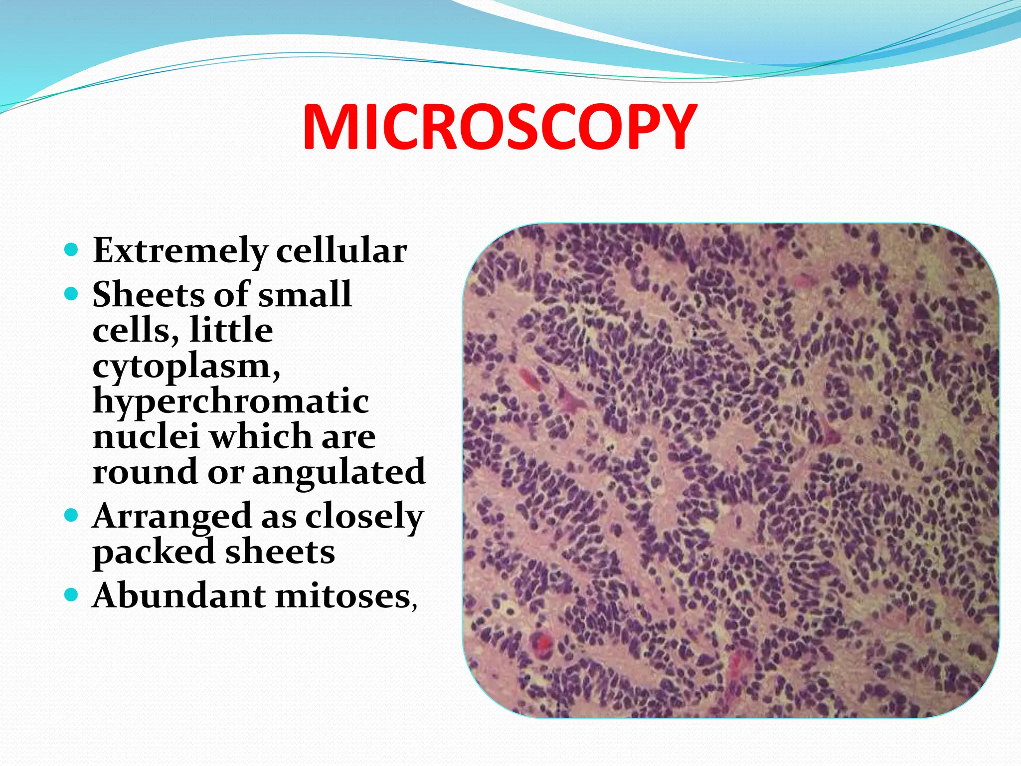 MICROSCOPY
 Extremely cellular
 Sheets of small
cells, little
cytoplasm,
hyperchromatic
nuclei which are
round or angulated
 Arranged as closely
packed sheets
 Abundant mitoses,
 