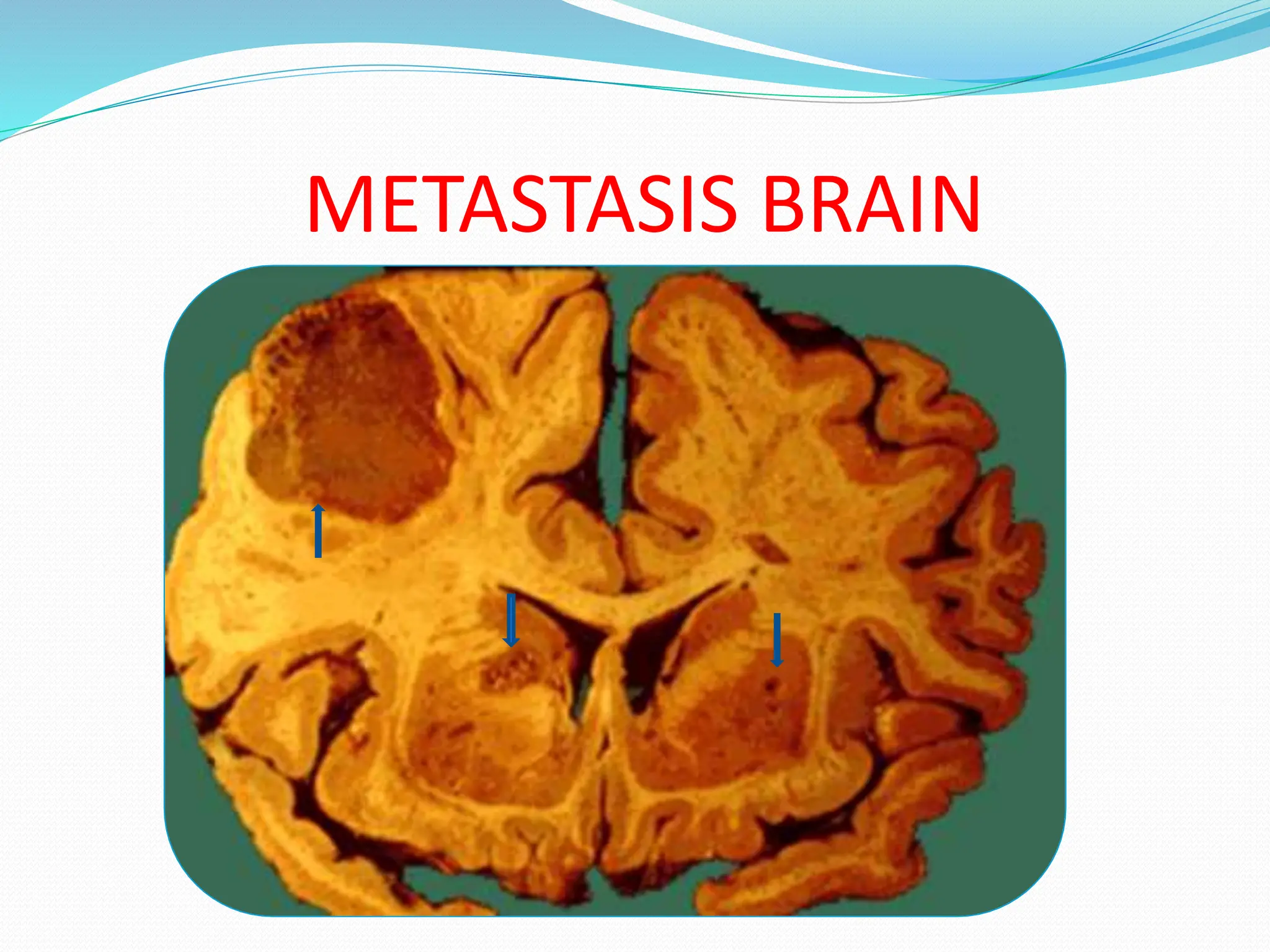 METASTASIS BRAIN
 
