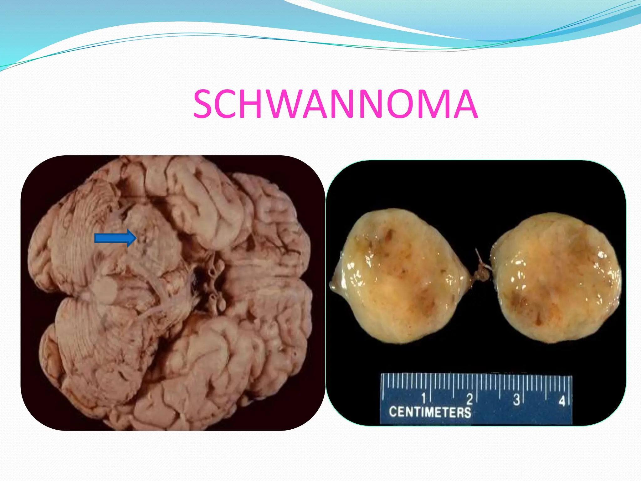 SCHWANNOMA
 