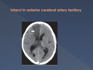 Infarct in anterior cerebral artery territory
 