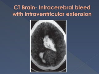 CT Brain- Intracerebral bleed
with intraventricular extension
 
