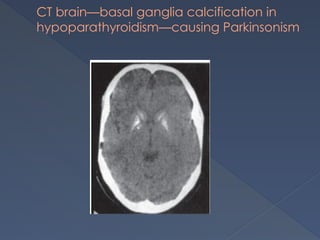CT brain—basal ganglia calcification in
hypoparathyroidism—causing Parkinsonism
 