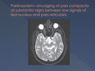 Parkinsonism—smudging of pars compacta
of substantia nigra between low signals of
red nucleus and pars reticularis
 