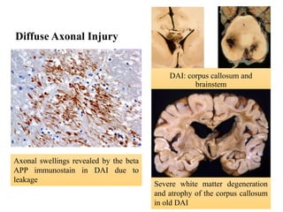 CNS trauma \ head trauma \ brain injury . | PDF