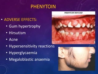 PHENYTOIN
• ADVERSE EFFECTS:
• Gum hypertrophy
• Hirsutism
• Acne
• Hypersensitivity reactions
• Hyperglycaemia
• Megaloblastic anaemia
 