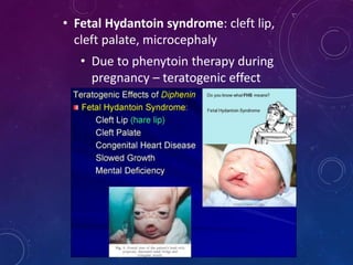 • Fetal Hydantoin syndrome: cleft lip,
cleft palate, microcephaly
• Due to phenytoin therapy during
pregnancy – teratogenic effect
 