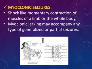  MYOCLONIC SEIZURES:
• Shock like momentary contraction of
muscles of a limb or the whole body.
• Myoclonic jerking may accompany any
type of generalized or partial seizures.
 