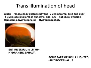 Trans illumination of head
When Translucency extends beyond 2 CM in frontal area and over
1 CM in occipital area is abnormal and S/O – sub dural effusion
Hematoma, hydrocephalus , Hydranencephaly




   ENTIRE SKULL IS LIT UP -
   HYDRANENCEPHALY.
                                  SOME PART OF SKULL LIGHTED
                                  - HYDROCEPHALUS
 