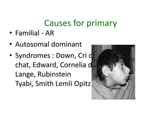 Causes for primary
• Familial - AR
• Autosomal dominant
• Syndromes : Down, Cri du
  chat, Edward, Cornelia de
  Lange, Rubinstein
  Tyabi, Smith Lemli Opitz.
 