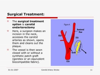 Surgical Treatment: The  surgical treatment option  is  carotid endarterectomy Here, a surgeon makes an incision in the neck, accesses the carotid arteries as shown, opens them and cleans out the plaque.  The vessel is then sewn closed with or without a synthetic patch graft (goretex or an equivalent biocompatible fabric). 