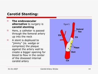 Carotid Stenting: The endovascular alternative  to surgery is  carotid stenting   Here, a catheter is passed through the femoral artery up into the neck A stent is deployed to "jimmy" (ie. wedge or compress) the plaque against the artery wall to create a bigger opening for blood to flow in the center of the diseased internal carotid artery 