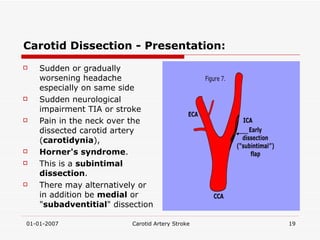 Carotid Dissection - Presentation: Sudden or gradually worsening headache especially on same side  Sudden neurological impairment TIA or stroke  Pain in the neck over the dissected carotid artery ( carotidynia ),  Horner's syndrome .  This is a  subintimal dissection .  There may alternatively or in addition be  medial  or " subadventitial " dissection 