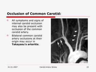 Occlusion of Common Carotid: All symptoms and signs of internal carotid occlusion may also be present with occlusion of the common carotid artery.  Bilateral common carotid artery occlusions at their origin may occur in  Takayasu's arteritis .  