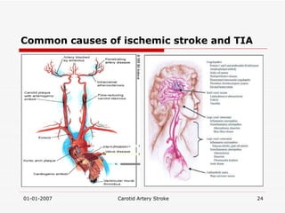 Common causes of ischemic stroke and TIA 
