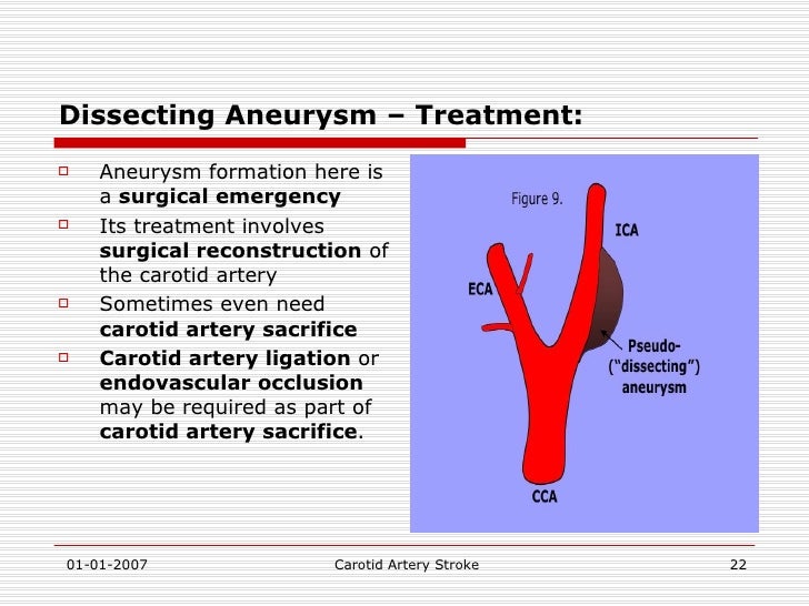 Carotid Artery Stroke