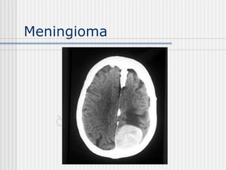 Meningioma
 