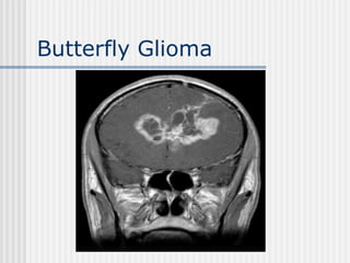 Butterfly Glioma
 
