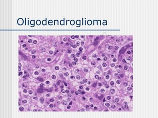 Oligodendroglioma
 