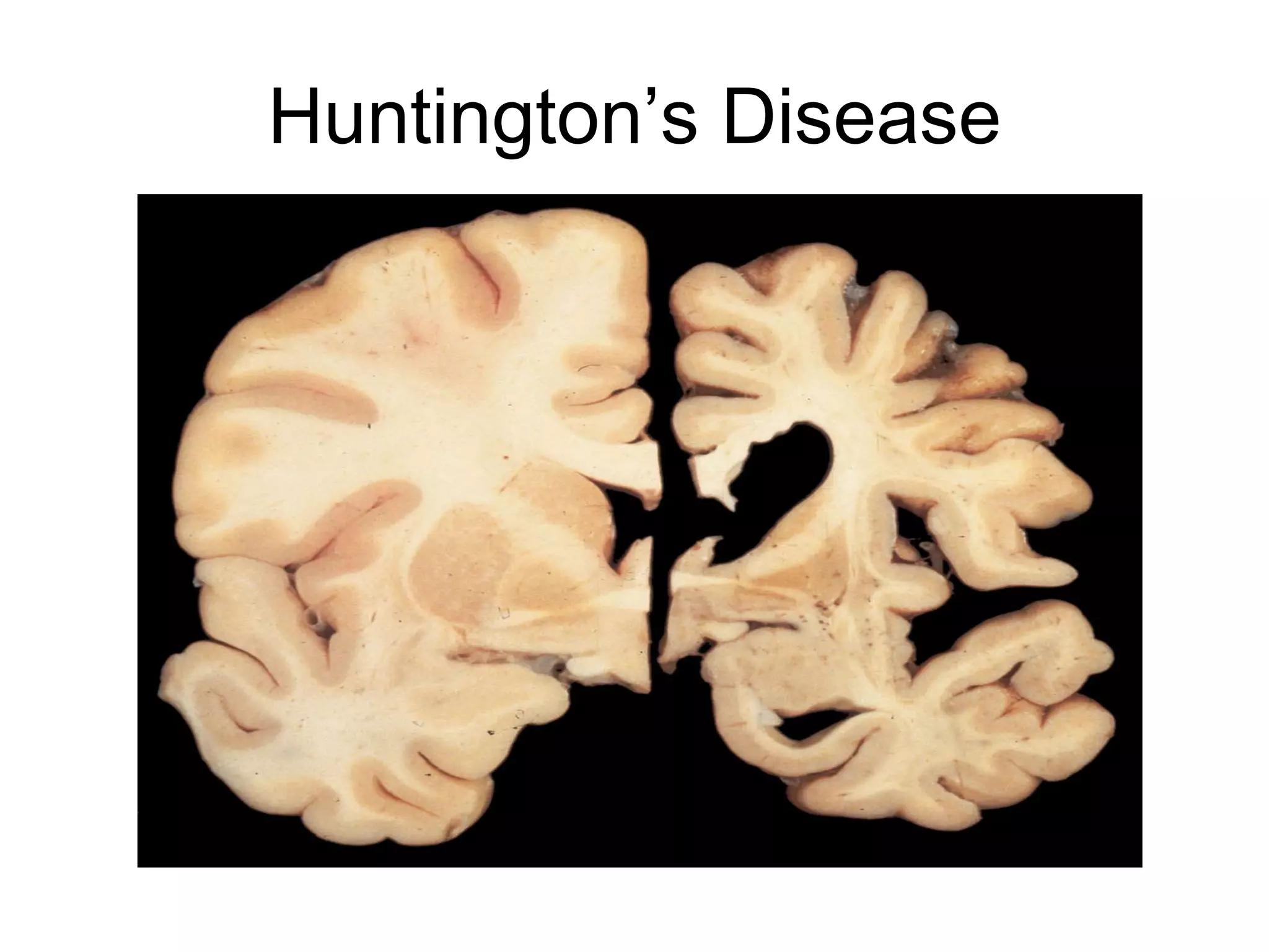 Huntington’s Disease 