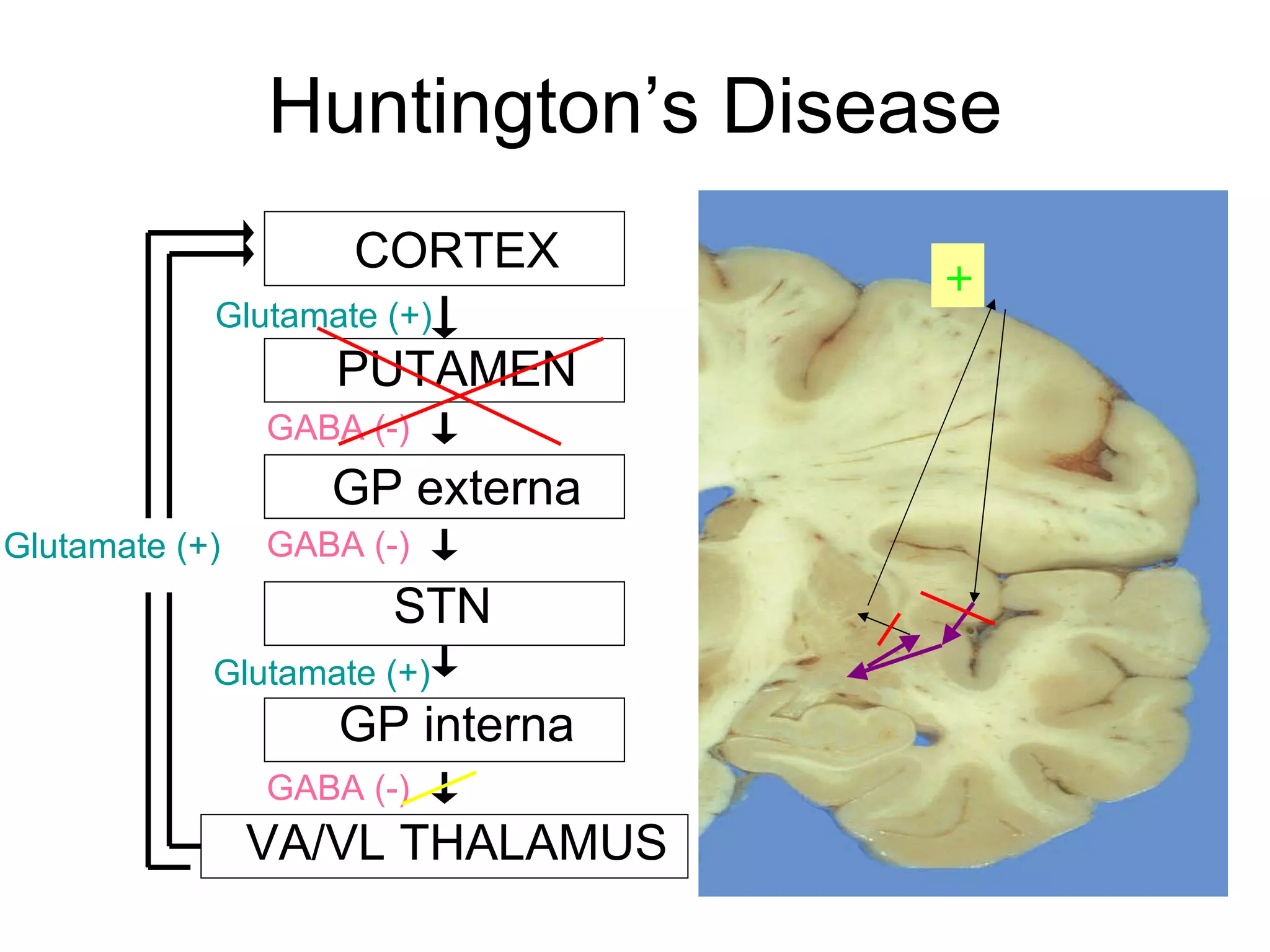 Huntington’s Disease CORTEX PUTAMEN GP externa STN GP interna VA/VL THALAMUS Glutamate (+) GABA (-) Glutamate (+) GABA (-) GABA (-) Glutamate (+) + 