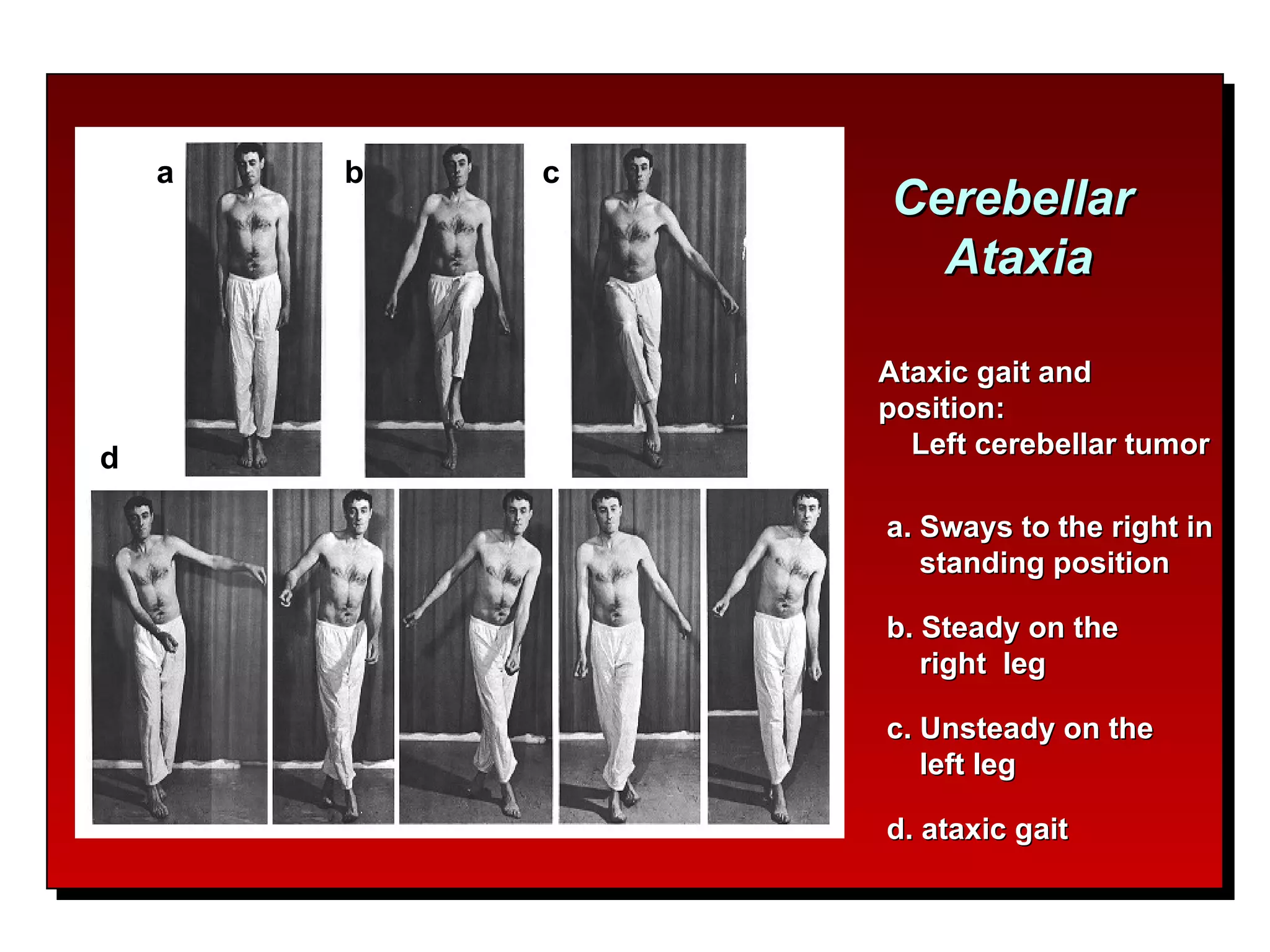 Cerebellar  Ataxia Ataxic gait and position:  Left cerebellar tumor a. Sways to the right in standing position b. Steady on the  right  leg c. Unsteady on the  left leg d. ataxic gait a b c d 