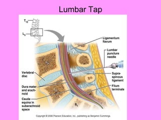 Lumbar Tap 